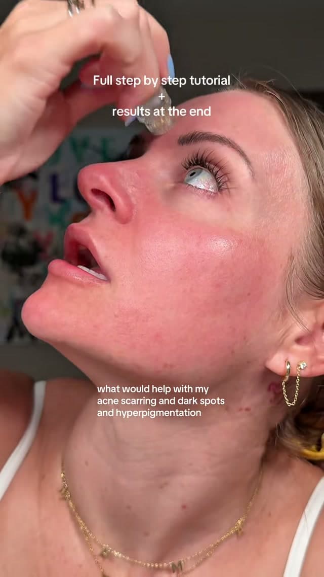 Qure Skincare ad: Hesitant To Start Micro-Infusion? Here’s what you need to know